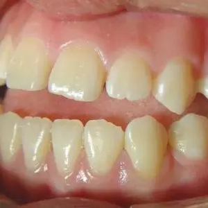 牙齿排列不整齐怎么办?